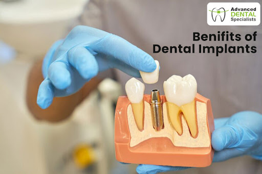Affordable Dental Implants – Tooth Implants