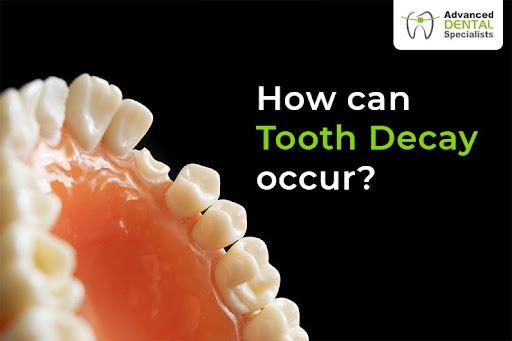 Common Symptoms Of Tooth Decay?